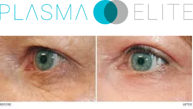 Plasma elite Fibroblast belfast